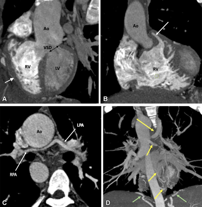 Preoperative appearance of tetralogy of Fallot with pulmonary atresia in a male infant. (A) Sagittal oblique maximum intensity projection (MIP) CT image shows right ventricular hypertrophy (white arrow), VSD (black double arrow), and overriding of the aorta. MPA is not visualized. (B) Coronal oblique MIP CT image shows pulmonary atresia (white arrow). (C) Axial oblique MIP CT image shows severe hypoplasia of the branch pulmonary arteries. MPA is absent. Thin but confluent branch pulmonary arteries produce the typical “seagull wing” appearance. White arrows indicate RPA and LPA. (D) Coronal oblique MIP CT image shows multiple MAPCAs arising from the descending thoracic aorta (yellow arrows) and upper abdominal aorta (green arrows). Ao = aorta, LPA = left pulmonary artery, LV = left ventricle, MAPCA = major aortopulmonary collateral artery, MPA = main pulmonary artery, RPA = right pulmonary artery, RV = right ventricle, VSD = ventricular septal defect.