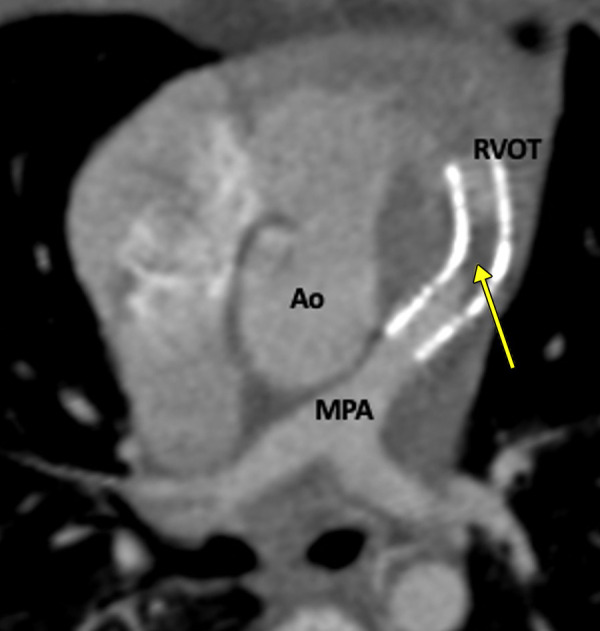 Postprocedural appearance of tetralogy of Fallot after RVOT stent palliation in a 1-year-old boy. Axial oblique contrast-enhanced CT image shows a stent in the RVOT extending into the MPA. A thrombus is observed in the stent (yellow arrow). Ao = aorta, MPA = main pulmonary artery, RVOT = right ventricular outflow tract.