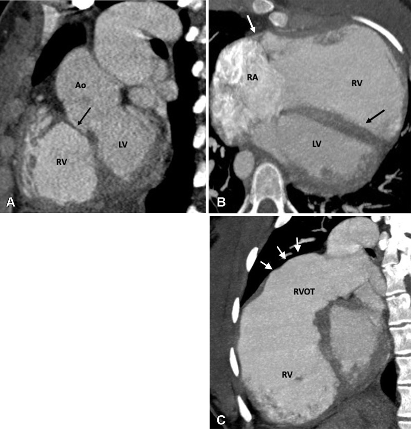 Postoperative appearance of tetralogy of Fallot after transannular patch repair in a 15-year-old boy. (A) Sagittal oblique maximum intensity projection (MIP) CT image shows a VSD patch (black arrow). (B) Axial oblique MIP CT image shows grossly dilated RA and RV. The severe degree of RV dilatation leads to abnormal orientation of the intraventricular septum (directed posteriorly) (black arrow) and narrowing of right atrioventricular groove (white arrow). (C) Sagittal oblique MIP CT image shows dilated RV and RVOT. The large caliber of the RVOT is due to the transannular patch (arrows), which is noncontractile, unlike the rest of the RV myocardium. Ao = aorta, LV = left ventricle, RA = right atrium, RV = right ventricle, RVOT = right ventricular outflow tract, VSD = ventricular septal defect.