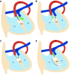 Diagram shows four types of ventricular septal defect (VSD). The
relationship between the outlet septum (green) and septomarginal trabecula (SMT)
defines the location of the VSD. (A) The outlet septum attaches to the anterior
limb of the septal band, resulting in a subaortic VSD. (B) The outlet septum
attaches to the posterior limb of the septal band, resulting in a subpulmonic
VSD. (C) In the doubly committed VSD, the outlet septum is absent. (D) A remote
VSD is not related to the outlet septum, and the distance between the VSD and
semilunar valve is greater than the size of the aortic valve. Ao = aorta, LV =
left ventricle, PA = pulmonary artery, RV = right ventricle.