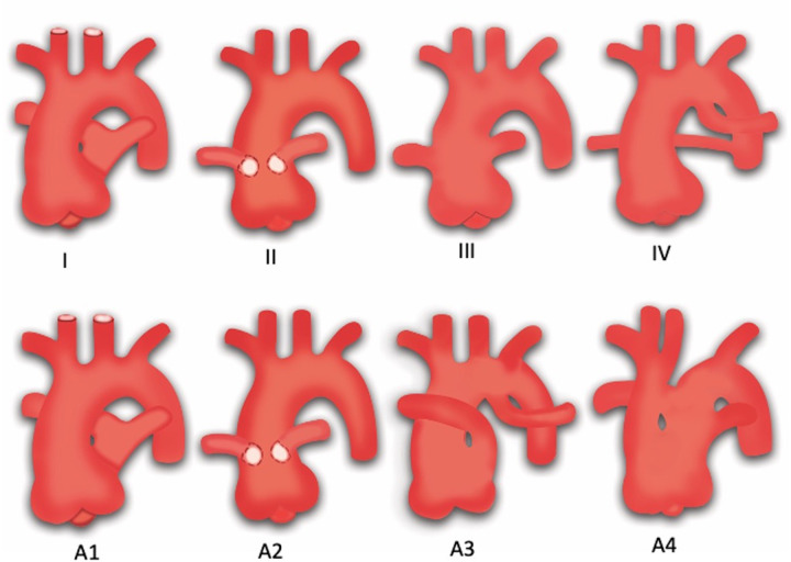 Diagram shows two commonly used classification systems for truncus arteriosus. Top row represents the Collett and Edwards system. Type I truncus arteriosus is characterized by origin of the main pulmonary trunk from the truncus, which further divides into the right and left pulmonary arteries; type II is characterized by the separate origin of the right and left pulmonary arteries from the posterior aspect of the truncus; type III is characterized by the separate origin of the right and left pulmonary arteries from the lateral aspect of the truncus; and type IV represents pseudotruncus (pulmonary atresia with a ventricular septal defect). Bottom row represents the Van Praagh system. Types A1 and A2 are equivalent to the Collett and Edwards types I and II, respectively; type A3 is characterized by atresia of the left or right pulmonary artery, with collateral flow to the ipsilateral lung; and type A4 is characterized by the presence of an associated interrupted aortic arch. (Adapted, with permission, from references 131 and 132.)