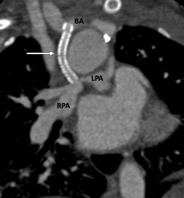 Postprocedural appearance of tetralogy of Fallot after modified BT shunt at birth followed by stent placement in a 2-month-old male infant. Coronal oblique contrast-enhanced CT image shows a patent stent (white arrow) in the right modified BT shunt, made between the right brachiocephalic artery and right pulmonary artery at birth. The shunt underwent stenosis, which was relieved by stent placement. The stent scaffold appears intact, and there is uniform contrast agent opacification of the stent without any stenosis or thrombosis. BA = brachiocephalic artery, BT = Blalock-Taussig, LPA = left pulmonary artery, RPA = right pulmonary artery.