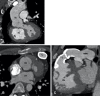 Postoperative (Rastelli procedure) appearance of dextrotransposition
of the great arteries with VSD and pulmonary stenosis after an RV-PA
conduit, VSD closure, and LV-Ao routing in a 27-year-old man. (A) Coronal
oblique maximum intensity projection (MIP) CT image shows tunnel repair of
the VSD. The LV is routed to the Ao. No evidence of any tunnel stenosis is
observed. (B) Axial and (C) sagittal oblique MIP CT images show the RV-PA
conduit. There is diffuse circumferential calcification of the conduit
without any focal stenosis. The pressure gradients were elevated at
echocardiography and catheter angiography. The RV is dilated. Ao = aorta, C
= conduit, LA = left atrium, LV = left ventricle, MPA = main PA, PA =
pulmonary artery, RV = right ventricle, T = tunnel, VSD = ventricular septal
defect.