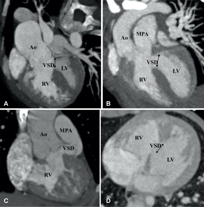 Types of ventricular septal defects (VSDs). (A) Subaortic VSD (double arrow) in a 1-year-old boy with double-outlet right ventricle (DORV). Reformatted coronal maximum intensity projection (MIP) CT image shows greater than 50% aortic overriding. The pulmonary valve and MPA were severely stenotic (not shown). (B) Subpulmonic VSD (double arrow) in a 2-year-old boy with DORV. Reformatted coronal MIP CT image shows the origin of both great vessels from the RV. (C) Doubly committed VSD in a 2-year-old girl with DORV. Reformatted coronal MIP CT image shows the origin of both great vessels from the RV. VSD is closely related to both the semilunar valves (doubly committed). (D) Remote VSD (double arrow) in an infant with DORV. Axial MIP CT image shows remote intramuscular VSD. Ao = aorta, LV = left ventricle, MPA = main pulmonary artery, RV = right ventricle.