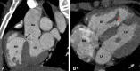 Postoperative appearance of tetralogy of Fallot after total correction
in a 12-year-old boy. (A) Sagittal oblique and (B) axial maximum intensity
projection CT images show perimembranous (black arrow in A) and mid muscular
(red arrow in B) VSD patches. Ao = aorta, LA = left atrium, LV = left
ventricle, RA = right atrium, RV = right ventricle, VSD = ventricular septal
defect.