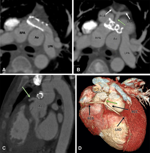 Postoperative appearance after an arterial switch procedure and LPA stent placement for treatment of dextrotransposition of the great arteries in a 14-year-old boy.(A) Axial maximum intensity projection (MIP) CT image shows the location of the main pulmonary artery anterior to the aorta. The patent stent is seen in the proximal LPA. The origin of the RPA is jailed. Stent placement was done to relieve recurrent LPA stenosis. (B) Axial and (C) sagittal MIP CT images show a single coronary artery (green arrow). A single common trunk arises from the aorta, which divides into the RCA and LM (white arrows in B). The LPA with stent is abutting the single coronary artery at its origin, but no evidence of ostial stenosis is seen. The aortic root appears dilated. (D) Volume-rendered image confirms the single coronary artery arising from right coronary sinus. Ao = aorta, LAD = left anterior descending artery, LM = left main trunk, LPA = left pulmonary artery, RCA = right coronary artery, RCC = right coronary sinus, RPA = right pulmonary artery.