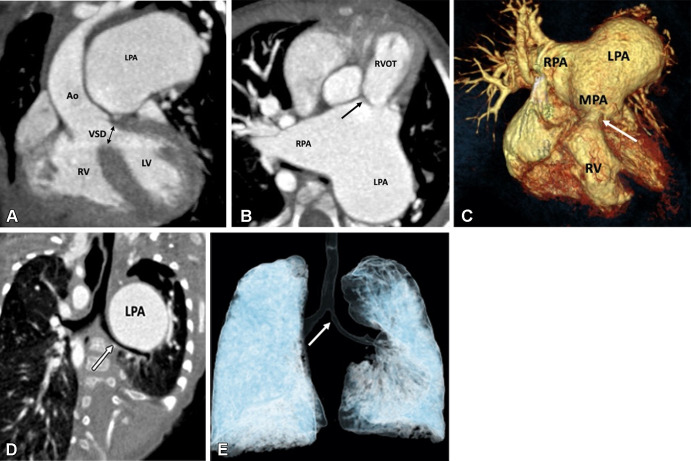 Preoperative appearance of tetralogy of Fallot with rudimentary pulmonary valves in a male infant. (A) Coronal oblique maximum intensity projection (MIP) CT image shows right ventricular hypertrophy, VSD (black double arrow), and overriding of the aorta. LPA is massively dilated. (B) Axial oblique MIP CT image shows hypoplasia of pulmonary valve ring with rudimentary cusps (black arrow). The MPA and its branches are massively dilated. Dilatation of the pulmonary artery and its branches occurs because of stenosis of the pulmonary valve and the antegrade fast flow. (C) Three-dimensional (3D) volume-rendered image further confirms the pulmonary stenosis (white arrow) and massive dilatation of the MPA and its branches. (D) Coronal oblique multiplanar reconstruction CT image shows compression of the left main bronchus (white arrow) due to a massively enlarged LPA. (E) 3D volume-rendered image further confirms the bronchial narrowing. The left main bronchus appears diffusely narrowed (white arrow) as compared with the right main bronchus, with focal stenosis in the osteoproximal part. Ao = aorta, LPA = left pulmonary artery, LV = left ventricle, MPA = main pulmonary artery, RPA = right pulmonary artery, RV = right ventricle, RVOT = right ventricular outflow tract, VSD = ventricular septal defect.