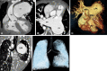 Preoperative appearance of tetralogy of Fallot with rudimentary pulmonary
valves in a male infant. (A) Coronal oblique maximum intensity projection (MIP)
CT image shows right ventricular hypertrophy, VSD (black double arrow), and
overriding of the aorta. LPA is massively dilated. (B) Axial oblique MIP CT
image shows hypoplasia of pulmonary valve ring with rudimentary cusps (black
arrow). The MPA and its branches are massively dilated. Dilatation of the
pulmonary artery and its branches occurs because of stenosis of the pulmonary
valve and the antegrade fast flow. (C) Three-dimensional (3D) volume-rendered
image further confirms the pulmonary stenosis (white arrow) and massive
dilatation of the MPA and its branches. (D) Coronal oblique multiplanar
reconstruction CT image shows compression of the left main bronchus (white
arrow) due to a massively enlarged LPA. (E) 3D volume-rendered image further
confirms the bronchial narrowing. The left main bronchus appears diffusely
narrowed (white arrow) as compared with the right main bronchus, with focal
stenosis in the osteoproximal part. Ao = aorta, LPA = left pulmonary artery, LV
= left ventricle, MPA = main pulmonary artery, RPA = right pulmonary artery, RV
= right ventricle, RVOT = right ventricular outflow tract, VSD = ventricular
septal defect.