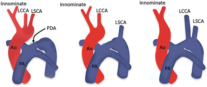 Diagrams showing the three types of interrupted aortic arch. Type A (left) is characterized by aortic arch interruption distal to the left subclavian artery origin; type B (middle) is characterized by aortic arch interruption between the origins of the left common carotid artery and left subclavian artery; and type C (right) is characterized by aortic arch interruption between the origins of the innominate and left common carotid arteries. Ao = aorta, LCCA = left common carotid artery, LSCA = left subclavian artery, PA = pulmonary artery, PDA = patent ductus arteriosus. (Reprinted, with permission, from reference 124.)