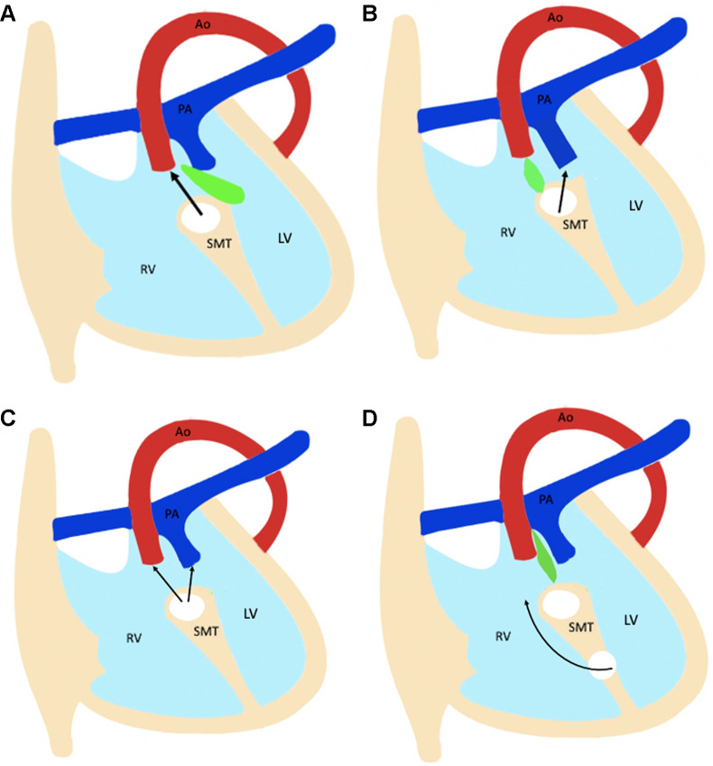 Diagram shows four types of ventricular septal defect (VSD). The relationship between the outlet septum (green) and septomarginal trabecula (SMT) defines the location of the VSD. (A) The outlet septum attaches to the anterior limb of the septal band, resulting in a subaortic VSD. (B) The outlet septum attaches to the posterior limb of the septal band, resulting in a subpulmonic VSD. (C) In the doubly committed VSD, the outlet septum is absent. (D) A remote VSD is not related to the outlet septum, and the distance between the VSD and semilunar valve is greater than the size of the aortic valve. Ao = aorta, LV = left ventricle, PA = pulmonary artery, RV = right ventricle.