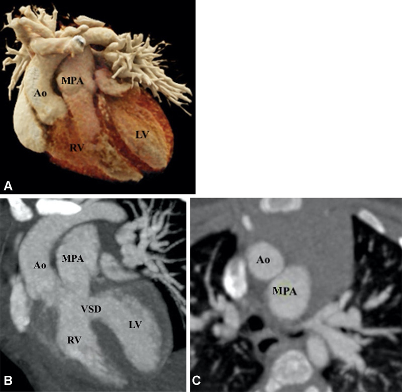 Preoperative appearance of TGA-type DORV in a 2-month-old female infant. (A) Cinematic rendering technique image shows both the great arteries arising from the right ventricle. Both the great vessel trunks run parallel to each other, with the aorta on the right side. (B) Coronal reformatted maximum intensity projection (MIP) CT image shows a subpulmonic VSD. (C) Axial MIP CT image shows the great vessels relationship. The aorta is seen anterior and to the right of the MPA, suggesting dextrotransposition (D-TGA type) relationship. Ao = aorta, DORV = double-outlet right ventricle, LV = left ventricle, MPA = main pulmonary artery, RV = right ventricle, TGA = transposition of the great arteries, VSD = ventricular septal defect.