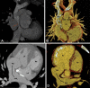 Postoperative appearance of levotransposition of the great arteries
after double-switch operation (Senning procedure and arterial switch) in an
8-year-old boy. (A) Coronal oblique maximum intensity projection (MIP) CT
image and (B) coronal oblique cut volume-rendered image show the systemic
venous limb of the baffle emptying systemic venous blood into the left
atrium and morphologic right ventricle (long curved black arrows). There is
evidence of severe stenosis in the systemic venous limb (red arrow). Also,
note the right and left pulmonary arteries (short straight black arrows in
B) lying on either side of the aorta as the normal postoperative appearance
of LeCompte maneuver. (C) Axial MIP CT image and (D) axial cut
volume-rendered images show the pulmonary venous limb of the baffle emptying
pulmonary venous blood into the right atrium and morphologic left ventricle
(long curved black arrow). Ao = aorta, IVC = inferior vena cava, LA = left
atrium, LPA = left pulmonary artery, LV = left ventricle, PVL = pulmonary
venous limb, RPA = right pulmonary artery, RA = right atrium, RV = right
ventricle, SVC = superior vena cava, SVL = systemic venous limb.
