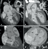 Types of ventricular septal defects (VSDs). (A) Subaortic VSD (double
arrow) in a 1-year-old boy with double-outlet right ventricle (DORV).
Reformatted coronal maximum intensity projection (MIP) CT image shows
greater than 50% aortic overriding. The pulmonary valve and MPA were
severely stenotic (not shown). (B) Subpulmonic VSD (double arrow) in a
2-year-old boy with DORV. Reformatted coronal MIP CT image shows the origin
of both great vessels from the RV. (C) Doubly committed VSD in a 2-year-old
girl with DORV. Reformatted coronal MIP CT image shows the origin of both
great vessels from the RV. VSD is closely related to both the semilunar
valves (doubly committed). (D) Remote VSD (double arrow) in an infant with
DORV. Axial MIP CT image shows remote intramuscular VSD. Ao = aorta, LV =
left ventricle, MPA = main pulmonary artery, RV = right
ventricle.