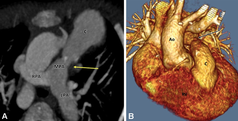 Postoperative appearance of truncus arteriosus after RV-PA conduit formation and VSD closure in a 13-year-old boy. (A) Axial maximum intensity projection CT image shows mild stenosis in the MPA at the anastomotic site of the conduit (yellow arrow). (B) Volume-rendered image confirms these findings. Ao = aorta, C = conduit, LPA = left PA, MPA = main PA, PA = pulmonary artery, RPA = right PA, RV = right ventricle, VSD = ventricular septal defect.