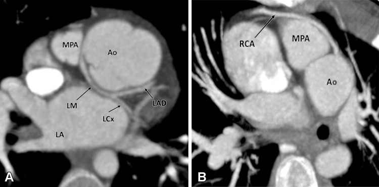 Postoperative appearance after an arterial switch procedure for treatment of dextrotransposition of the great arteries in a 21-year-old woman. (A) Axial maximum intensity projection (MIP) CT image shows anomalous origin of the LM from the right coronary sinus with retroaortic course before dividing into the LAD and LCx. (B) Axial MIP CT image shows high origin of the RCA from the sinotubular junction with prepulmonic course before entering into the right atrioventricular groove. Ao = aorta, LA = left atrium, LAD = left anterior descending artery, LCx = left circumflex artery, LM = left main trunk, MPA = main pulmonary artery, RCA = right coronary artery.