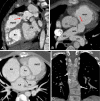 Postoperative appearance of TOF-type DORV after VSD closure with LV
routing, infundibular resection, and patch augmentation of the RVOT up to
the main pulmonary artery in a 4-month-old male infant. (A) Sagittal oblique
and (B) axial multiplanar reconstruction CT images show dilated RV and RVOT.
There is residual subvalvular narrowing (red arrow). The residual pulmonary
valve tissue is shown with a black arrow. The MPA, RPA, and LPA appear
normal. (C) Axial maximum intensity projection (MIP) CT image shows
anomalous origin of the left main coronary artery (black arrow) from the
noncoronary sinus with retroaortic course. (D) Coronal reformatted MIP CT
image shows multiple hemivertebrae (white arrows). Ao = aorta, DORV =
double-outlet right ventricle, LA = left atrium, LM = left main, LPA = left
pulmonary artery, LV = left ventricle, MPA = main pulmonary artery, PV =
pulmonary valve, RA = right atrium, RPA = right pulmonary artery, RV = right
ventricle, RVOT = right ventricular outflow tract, TOF = tetralogy of
Fallot, VSD = ventricular septal defect.