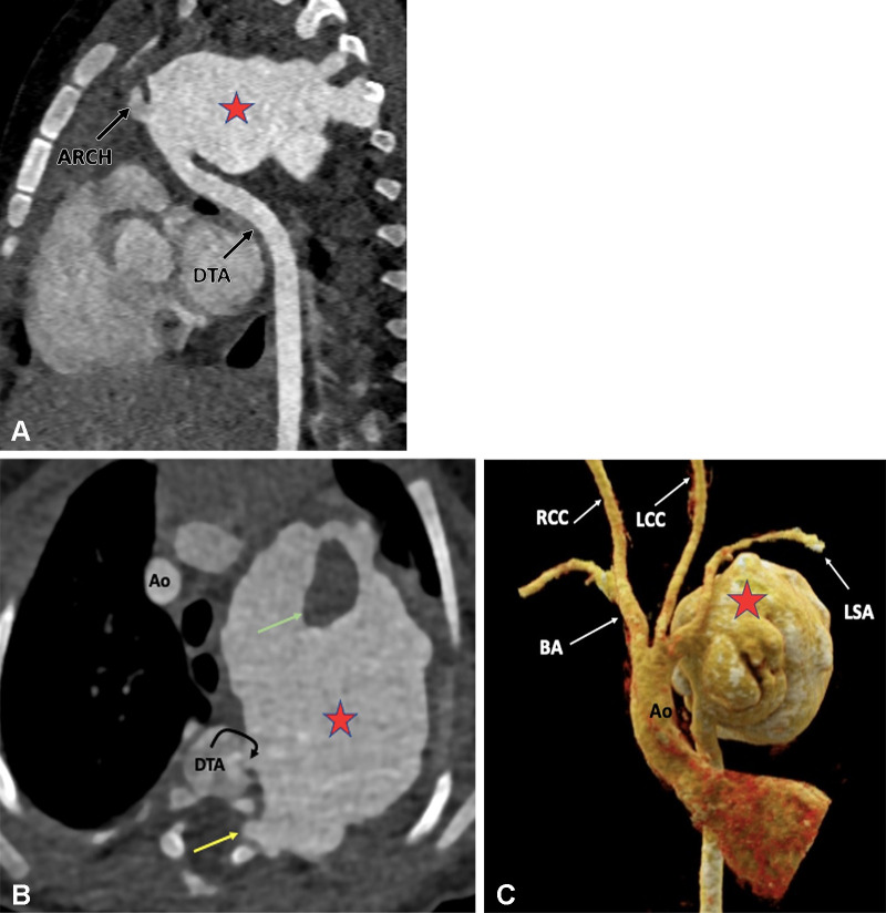 Postoperative appearance of type A interrupted aortic arch after primary anastomosis repair in a 17-year-old boy. (A) Sagittal oblique maximum intensity projection (MIP) CT image shows a large pseudoaneurysm (red star) arising at the site of anastomosis (junction of aortic arch and descending thoracic aorta). (B) Axial MIP CT image shows the large lobulated pseudoaneurysm (red star) occupying the thoracic cavity, displacing the adjacent lung parenchyma peripherally and extending into the neural foramen (yellow arrow). A nonenhancing hypodense thrombus (green arrow) is observed within it. (C) Volume-rendered image confirms the findings. Note the broad neck of the pseudoaneurysm (red star) arising from the site of anastomosis. Ao = aorta, BA = brachiocephalic artery, DTA = descending thoracic aorta, LCC = left common carotid artery, LSA = left subclavian artery, RCC = right common carotid artery.