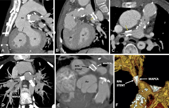 Postoperative appearance of tetralogy of Fallot with pulmonary atresia after RV-PA conduit (pulmonary homograft) repair, unifocalization of the MAPCAs, and angioplasty of the bilateral pulmonary arteries in a 14-year-old boy. (A) Sagittal oblique maximum intensity projection (MIP) CT image shows a VSD patch (black arrow). (B) Sagittal oblique and (C) axial oblique MIP CT images show RV-PA conduit with multifocal degenerative calcifications in conduit wall. Patent stents are observed in the LPA and RPA (yellow arrow). Stent placement was performed to relieve recurrent branch PA stenosis. (D) Axial oblique MIP CT image shows a stent in the osteoproximal RPA. Another good-sized vessel is observed arising from the RPA which has a unifocalized MAPCA attached to it (white arrow). (E) Sagittal oblique multiplanar reconstruction and (F) volume-rendered images show the origin of the unifocalized MAPCA (white arrow) just proximal to the RPA stent (black arrow in E, white arrow in F). Severe stenosis is noted in the osteoproximal segment of the unifocalized MAPCA. Ao = aorta, C = conduit, LPA = left PA, LV = left ventricle, MAPCA = major aorto-pulmonary collateral arteries, PA = pulmonary artery, RPA = right PA, RV = right ventricle, VSD = ventricular septal defect.