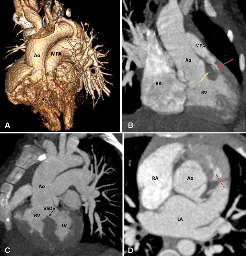 Preoperative appearance of TOF-type DORV in a 2-month-old male infant. (A) Volume-rendered image and (B) coronal oblique maximum intensity projection (MIP) CT image show the great arteries arising from the RV. Severe pulmonary stenosis is seen (red arrow). Note the subpulmonic conus (yellow arrow in B). (C) Sagittal MIP CT image shows the subaortic VSD (black double arrow). (D) Axial reformatted MIP CT image shows the normal relationship of the great vessels; the aorta is situated posterior and rightward to the pulmonary trunk. There is hypertrophy of the pulmonic infundibulum, causing severe RVOT stenosis (red arrow). Ao = aorta, DORV = double-outlet right ventricle, LA = left atrium, LV = left ventricle, MPA = main pulmonary artery, RA = right atrium, RV = right ventricle, RVOT = right ventricular outflow tract, TOF = tetralogy of Fallot, VSD = ventricular septal defect.