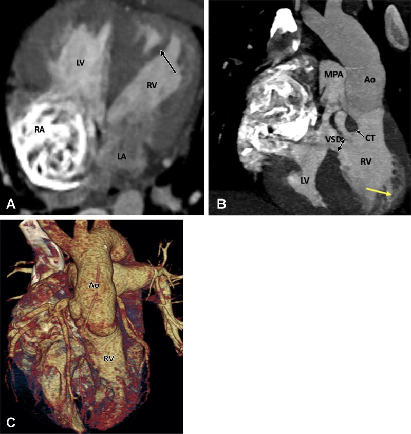 Preoperative appearance of congenitally corrected transposition of the great arteries in a 25-year-old woman. (A) Axial oblique maximum intensity projection (MIP) CT image shows atrioventricular discordance. The RV is identified by the moderator band (black arrow). (B) Coronal oblique MIP CT image shows ventriculoarterial discordance. The aorta arises from the left-sided RV, and the pulmonary artery arises from the right-sided LV. The RV is identified by the trabeculated wall (yellow arrow). A thick conal tissue (black arrow) is seen in the subpulmonic region. In the primitive ventricle, it is present in both the subpulmonic and subaortic regions. During transfer of the aorta to the LV, the subaortic component gets resorbed and is represented by fibrous continuity between the aortic and mitral valve leaflets. The subpulmonary component, however, persists and separates the pulmonary and tricuspid valve. A VSD is also seen (double arrow). (C) Volume-rendered image further confirms the levotransposition of the aorta, which is located leftward and anterior to the pulmonary trunk. Ao = aorta, CT = conal tissue, LA = left atrium, LV = left ventricle, MPA = main pulmonary artery, RA = right atrium, RV = right ventricle, VSD = ventricular septal defect.