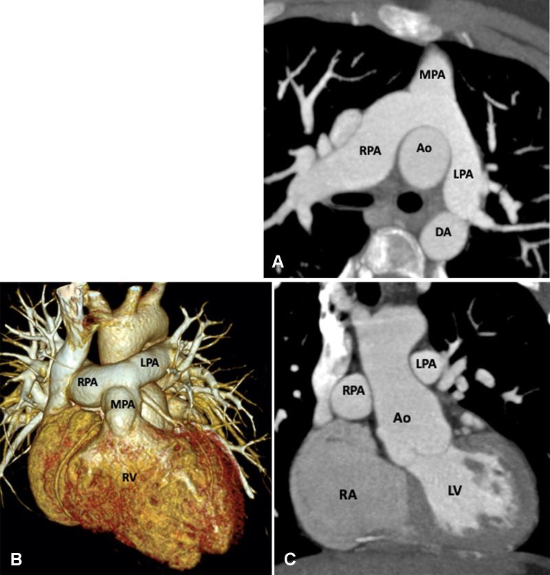 Postoperative appearance of dextrotransposition of the great arteries after an arterial switch with LeCompte maneuver in an 11-year-old boy. (A) Axial maximum intensity projection (MIP) CT image and (B) volume-rendered image show the location of the MPA anterior to the aorta. The branch pulmonary arteries bifurcate anterior to the ascending aorta and “drape over” it. The great arteries are lying directly in antero-posterior relation, and the right and left branch PA sizes are balanced. The positioning of the MPA anterior to the aorta is called the LeCompte maneuver. The purpose of the LeCompte maneuver is to maximize the length of the aorta, thus further reducing the risk of coronary artery kinking and stenosis. (C) Coronal MIP CT image shows mildly dilated aortic root. The RPA and LPA are seen lying on either side of the aorta. Ao = aorta, DA = descending aorta, LPA = left PA, LV = left ventricle, MPA = main PA, PA = pulmonary artery, RA = right atrium, RPA = right PA, RV = right ventricle.