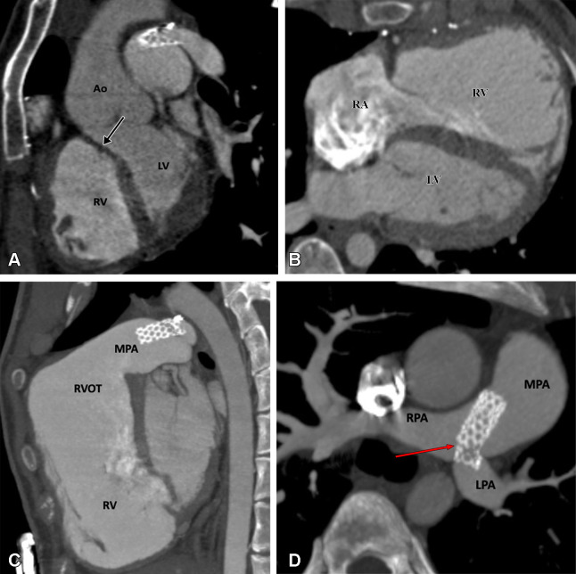 Postoperative appearance of tetralogy of Fallot after total correction and LPA stent placement in a 17-year-old girl. (A) Sagittal oblique maximum intensity projection (MIP) CT image shows a VSD patch (black arrow). (B) Axial oblique MIP CT image shows grossly dilated RA and RV. (C) Sagittal oblique MIP CT image shows dilated RV and RVOT. A patent stent is seen in the MPA extending into the LPA. Stent placement was performed to relieve recurrent LPA ostial stenosis. (D) Axial oblique MIP CT image shows a patent stent in the distal MPA extending into the LPA. There is proximal migration of the stent with fracture in stent scaffold integrity (red arrow), suggesting stent fracture. Ao = aorta, LPA = left pulmonary artery, LV = left ventricle, MPA = main pulmonary artery, RA = right atrium, RPA = right pulmonary artery, RV = right ventricle, RVOT = right ventricular outflow tract, VSD = ventricular septal defect.