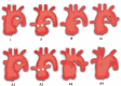 Diagram shows two commonly used classification systems for truncus
arteriosus. Top row represents the Collett and Edwards system. Type I truncus
arteriosus is characterized by origin of the main pulmonary trunk from the
truncus, which further divides into the right and left pulmonary arteries; type
II is characterized by the separate origin of the right and left pulmonary
arteries from the posterior aspect of the truncus; type III is characterized by
the separate origin of the right and left pulmonary arteries from the lateral
aspect of the truncus; and type IV represents pseudotruncus (pulmonary atresia
with a ventricular septal defect). Bottom row represents the Van Praagh system.
Types A1 and A2 are equivalent to the Collett and Edwards types I and II,
respectively; type A3 is characterized by atresia of the left or right pulmonary
artery, with collateral flow to the ipsilateral lung; and type A4 is
characterized by the presence of an associated interrupted aortic arch.
(Adapted, with permission, from references 131 and 132.)