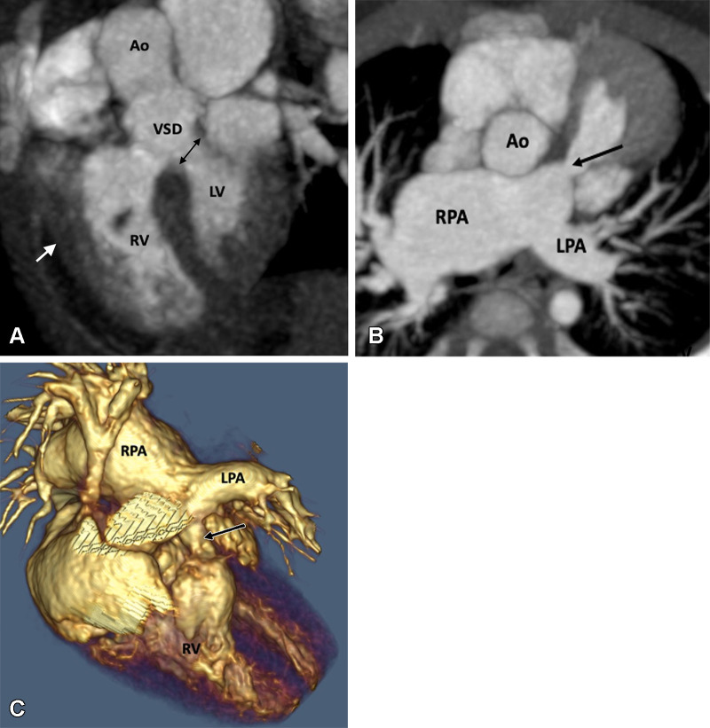 Preoperative appearance of tetralogy of Fallot with absent pulmonary valves in a male infant. (A) Sagittal oblique maximum intensity projection (MIP) CT image shows right ventricular hypertrophy (white arrow), VSD (black double arrow), and overriding of the aorta. (B) Axial oblique MIP CT image shows hypoplasia of pulmonary valve ring with absent pulmonary valves (black arrow). The MPA and its branches (right > left) are dilated. (C) Volume-rendered image further confirms the pulmonary stenosis (black arrow) and massive dilatation of the MPA and RPA. Ao = aorta, LPA = left pulmonary artery, LV = left ventricle, MPA = main pulmonary artery, RPA = right pulmonary artery, RV = right ventricle, VSD = ventricular septal defect.