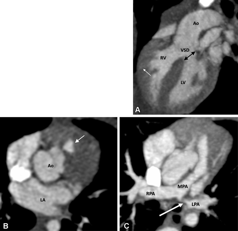 Preoperative appearance of classic tetralogy of Fallot with infundibular, valvular, and pulmonary obstructive components in a male infant. (A) Sagittal oblique maximum intensity projection (MIP) CT image shows right ventricular hypertrophy (white arrow), VSD (black double arrow), and overriding of the aorta. (B) Axial contrast-enhanced CT image shows infundibular pulmonary stenosis (white arrow). (C) Axial oblique MIP CT image shows small caliber MPA, RPA, and LPA. Severe stenosis is observed at the origin of the LPA (white arrow). Ao = aorta, LPA = left pulmonary artery, LA = left atrium, LV = left ventricle, MPA = main pulmonary artery, RPA = right pulmonary artery, RV = right ventricle, VSD = ventricular septal defect.