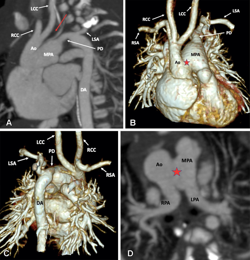 Preoperative appearance of type B interrupted aortic arch with aortopulmonary window in a neonate. (A) Sagittal oblique maximum intensity projection (MIP) CT image shows interrupted aortic arch (red arrow). Both the right and left common carotid arteries arise from the arch proximal to the site of interruption. The descending thoracic aorta is filled by a large left patent duct connecting the left pulmonary artery and descending thoracic aorta. (B) Anterior and (C) posterior three-dimensional volume-rendered images confirm the aortic arch interruption. The proximal ascending aorta and pulmonary trunk are connected, suggesting aortopulmonary window (red star in B). (D) Axial MIP CT image shows aortopulmonary window (red star). Ao = aorta, DA = descending aorta, LCC = left common carotid artery, LPA = left pulmonary artery, LSA = left subclavian artery, MPA = main pulmonary artery, PD = patent duct, RCC = right common carotid artery, RPA = right pulmonary artery, RSA = right subclavian artery.