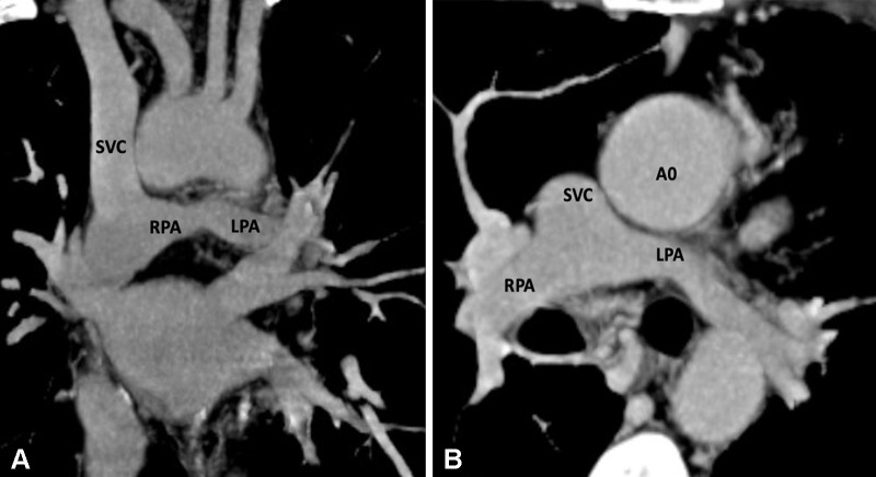 Postoperative appearance of DORV with functional single ventricle after bidirectional cavopulmonary shunt in a 31-month-old boy. (A) Coronal oblique and (B) axial maximum intensity projection CT images show end-to-side anastomosis of the superior vena cava to the right pulmonary artery after division of the superior cavoatrial junction. In this patient, bidirectional cavopulmonary shunt was performed as an intermediate procedure to staged Fontan operation. Ao = aorta, DORV = double-outlet right ventricle, LPA = left pulmonary artery, RPA = right pulmonary artery, SVC = superior vena cava.