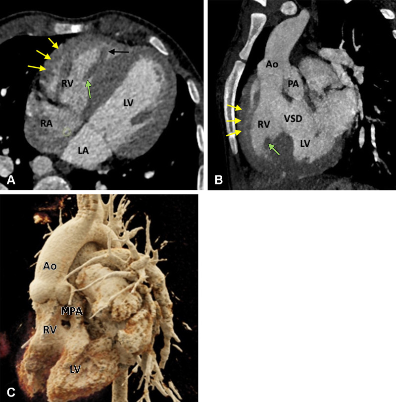 Preoperative appearance of dextrotransposition of the great arteries in a 4-year-old boy. (A) Axial oblique maximum intensity projection (MIP) CT image shows atrioventricular concordance. The RV is identified by a moderator band (black arrow), trabeculated wall (yellow arrows), and septal papillary muscle (green arrow). The LV, on the other hand, has a smooth wall without moderator band and septal papillary muscle. (B) Coronal oblique MIP CT image shows ventriculoarterial discordance. The aorta arises from the RV, and the PA arises from the LV. The RV is identified by trabeculated wall (yellow arrows) and septal papillary muscle (green arrow). A VSD is also seen. (C) Cinematic rendering technique image further confirms the dextrotransposition of the aorta, which is located rightward and anterior to the pulmonary trunk. Ao = aorta, LA = left atrium, LV = left ventricle, MPA = main PA, PA = pulmonary artery, RA = right atrium, RV = right ventricle, VSD = ventricular septal defect.