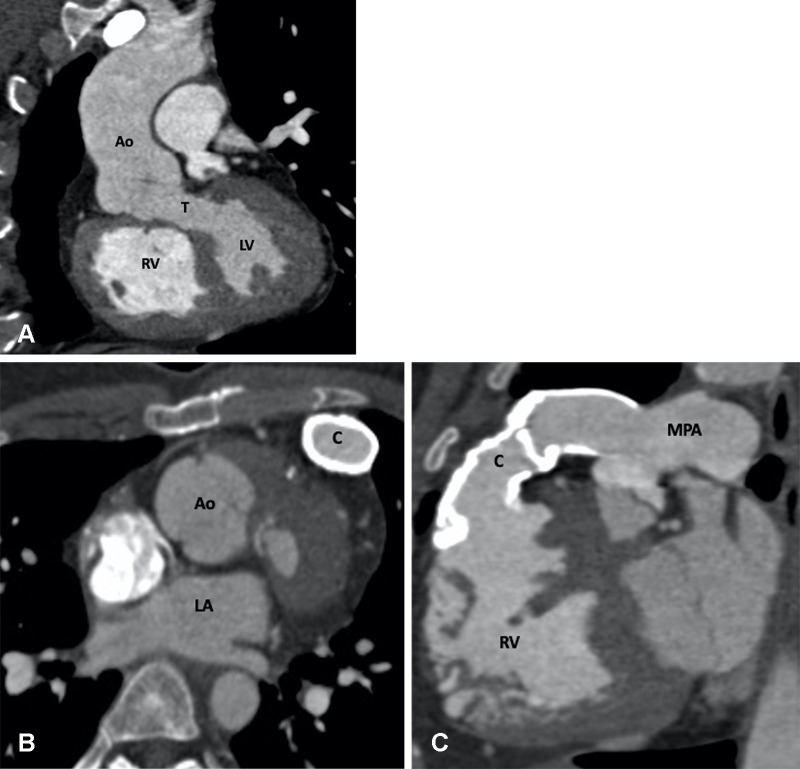 Postoperative (Rastelli procedure) appearance of dextrotransposition of the great arteries with VSD and pulmonary stenosis after an RV-PA conduit, VSD closure, and LV-Ao routing in a 27-year-old man. (A) Coronal oblique maximum intensity projection (MIP) CT image shows tunnel repair of the VSD. The LV is routed to the Ao. No evidence of any tunnel stenosis is observed. (B) Axial and (C) sagittal oblique MIP CT images show the RV-PA conduit. There is diffuse circumferential calcification of the conduit without any focal stenosis. The pressure gradients were elevated at echocardiography and catheter angiography. The RV is dilated. Ao = aorta, C = conduit, LA = left atrium, LV = left ventricle, MPA = main PA, PA = pulmonary artery, RV = right ventricle, T = tunnel, VSD = ventricular septal defect.