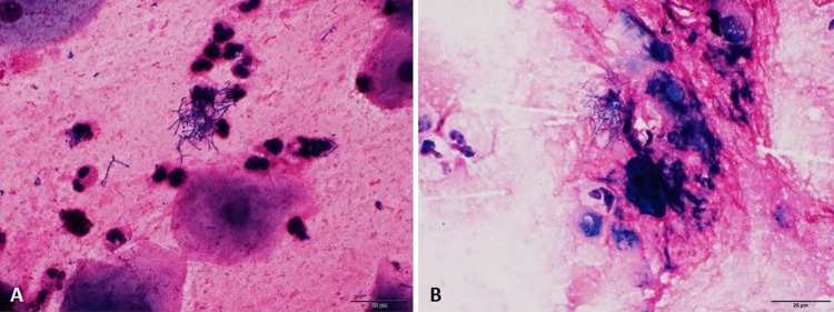 Rothia Aeria: A Great Mimicker Of The Nocardia Species - Pmc