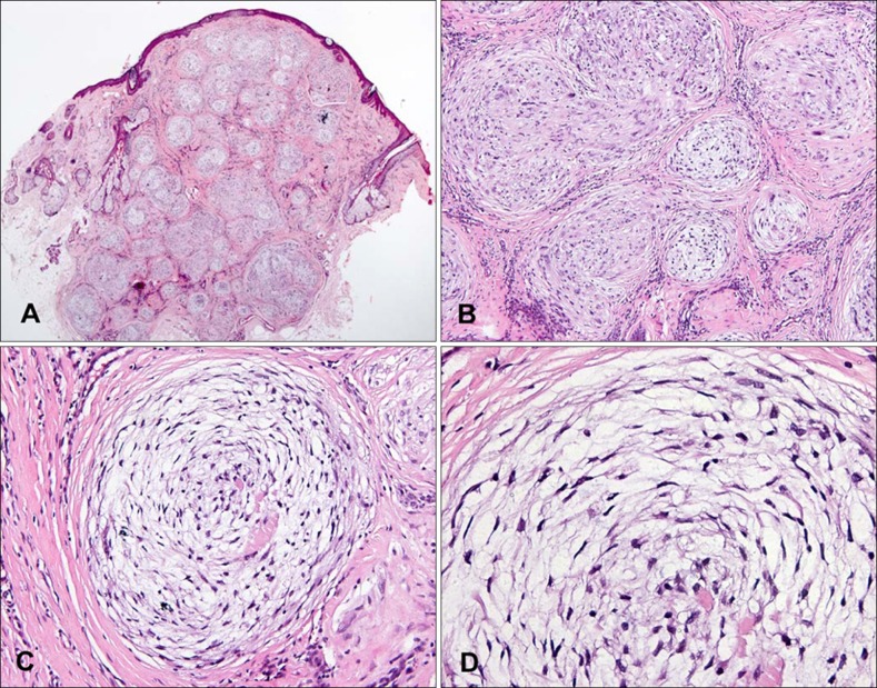 Myxoid Cellular Neurothekeoma: A New Entity of S100-Negative, CD68 ...