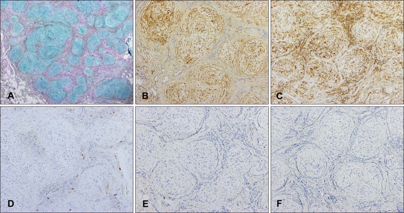 Myxoid Cellular Neurothekeoma: A New Entity of S100-Negative, CD68 ...