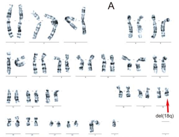 18q deletion syndrome – A case report - PMC