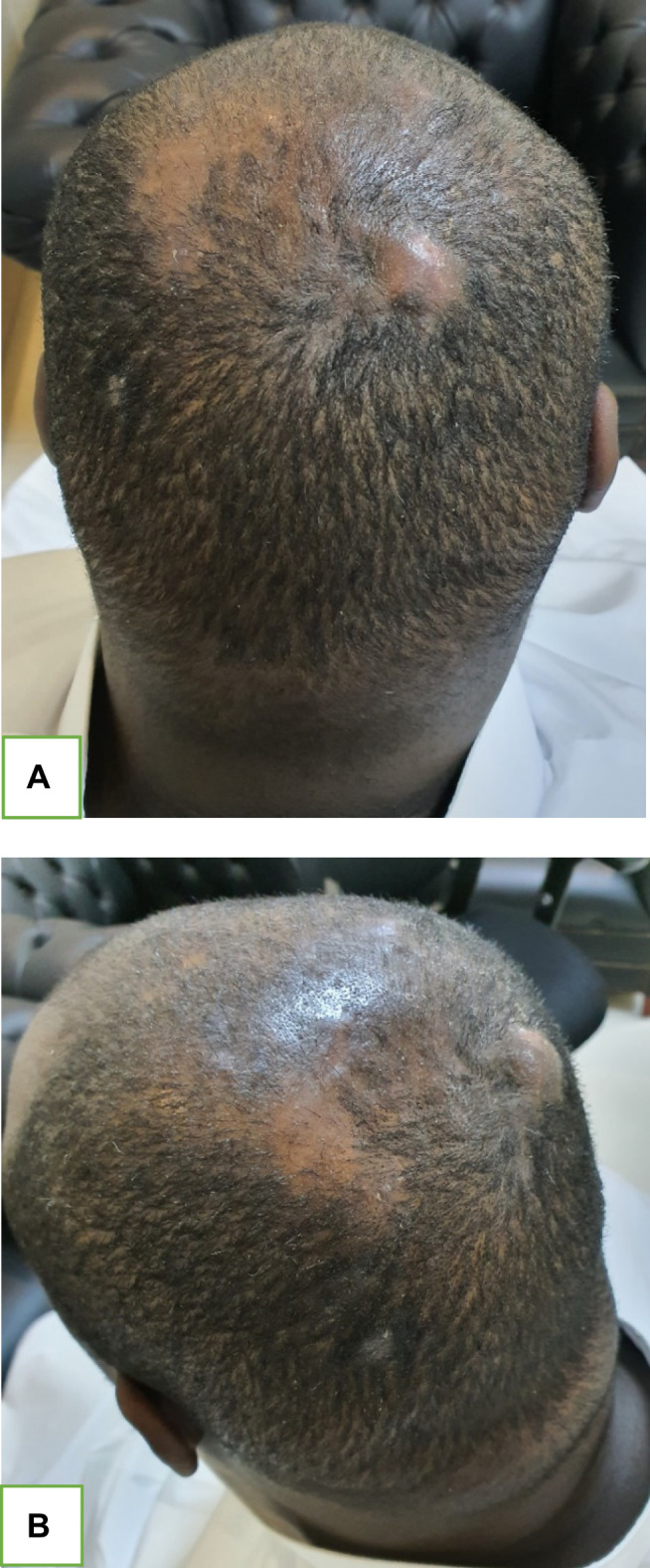 Recalcitrant Dissecting Cellulitis of the Scalp Treated Successfully ...