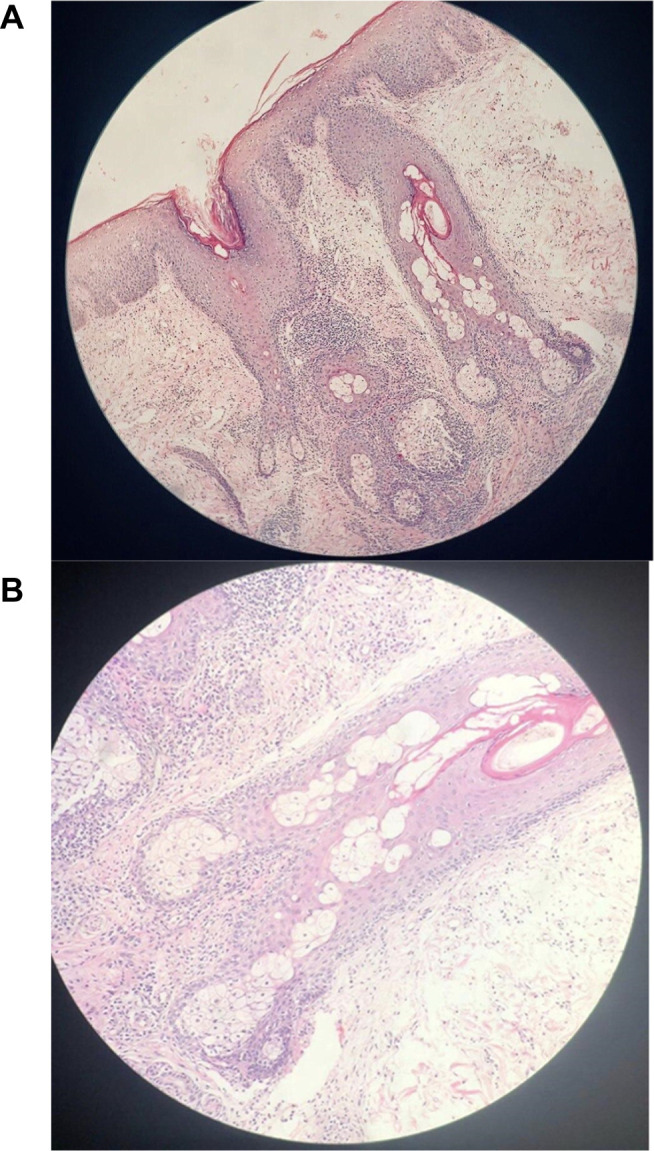 Recalcitrant Dissecting Cellulitis of the Scalp Treated Successfully ...