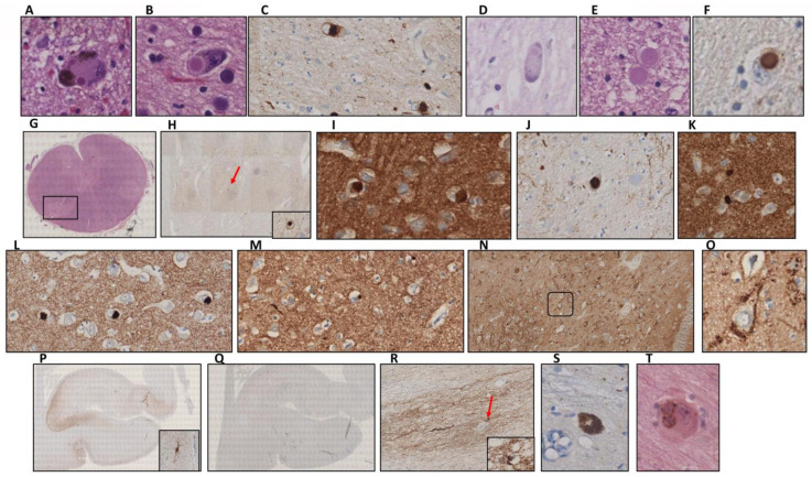 Norovirus Intestinal Infection And Lewy Body Disease In An Older 