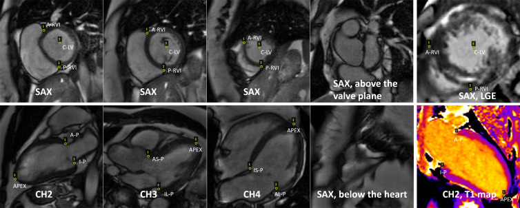 Example of cardiac MR images with landmarks. Three short-axis (SAX) views are shown on the top row. The first three images of the second row show examples of long-axis two-chamber (CH2), three-chamber (CH3), and four-chamber (CH4) views. The anterior point (A-P) and inferior point (I-P) were depicted on the two-chamber view. The inferolateral point (IL-P) and anteroseptal point (AS-P) were depicted on the three-chamber view, and the inferoseptal point (IS-P) and anterolateral point (AL-P) were depicted on the four-chamber view. The apical point (APEX) was depicted on all long-axis views. For the short-axis images, the anterior right ventricular (RV) insertion point (A-RVI), posterior RV insertion point (P-RVI), and left ventricular (LV) center point (C-LV) were depicted. Note that for some SAX sections (the rightmost column), no landmarks can be identified. The last column gives examples of late gadolinium enhancement (LGE) images and T1 maps. Transfer learning was applied to detect landmarks by using these imaging applications.