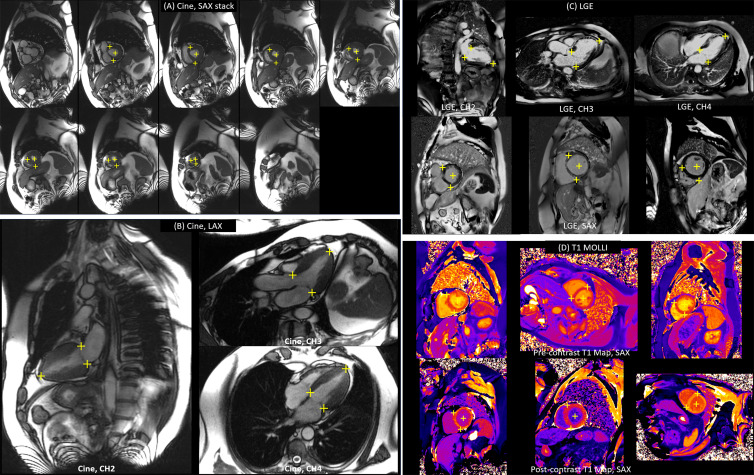 Examples of landmark detection. The left panels show landmark detection on (A) long-axis (LAX) and (B) short-axis (SAX) cine images. The right panels are examples of detection on (C) late gadolinium enhancement (LGE) and (D) T1 mapping modified Look-Locker inversion recovery (MOLLI) images. CH2 = two chamber, CH3 = three chamber, CH4 = four chamber.