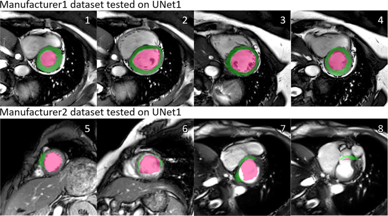 Illustration of the manufacturer shift problem. The upper row shows the performance of U-Net 1 tested on datasets from manufacturer 1, and the lower row shows the performance of U-Net 1 tested on datasets from manufacturer 2. A performance drop can be observed, in the form of undersegmentation. Numbers at upper right corner of each subfigure indicate different examples. Green regions denote the automatic myocardium segmentation results by the U-Net, while red regions denote the blood pool segmentation results.