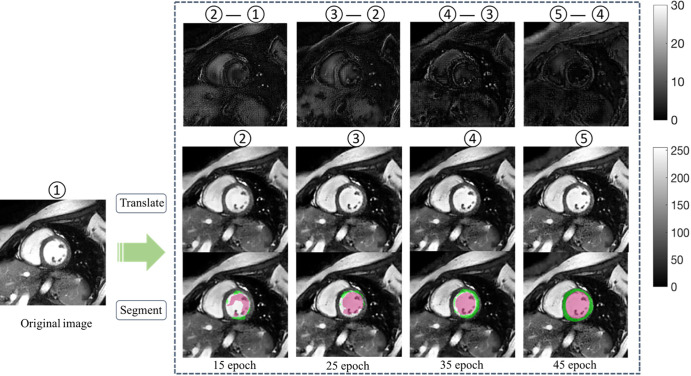 The performance of U-Net trained on one manufacturer dataset improved on dataset from another manufacturer, along with training epochs. Middle row shows adapted images at different epochs. Bottom row shows the corresponding segmentation results after manufacturer adaptation using the same U-Net. Upper row illustrates the subtle difference between the adapted images (scale indicated by gray-scale bar). Numbers 1–5 mark image at different adaptation stages, with 5 being the final adapted image. Green regions denote the automatic myocardium segmentation results by the U-Net, while red regions denote the blood pool segmentation results.