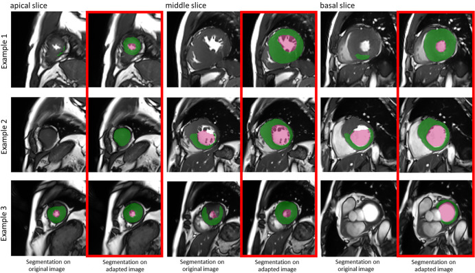 Three examples show boost of segmentation performance after manufacturer adaptation. Examples from apical, middle, and basal slices are given. In each subfigure, the left column shows segmentation results on original data from another manufacturer, while the right (red box) shows segmentation results on manufacturer-adapted data. Green regions denote the automatic myocardium segmentation results by the U-Net, while red regions denote the blood pool segmentation results.