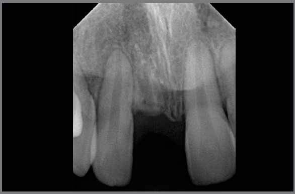 Management of ankylosed teeth using the decoronation technique ...