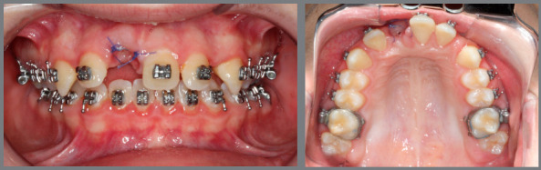 Management of ankylosed teeth using the decoronation technique ...