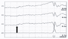 Bereitschaftspotential in a patient with functional myoclonus