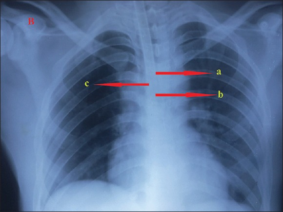 Armored Endotracheal Tube: Concerns in Intensive Care Unit - PMC