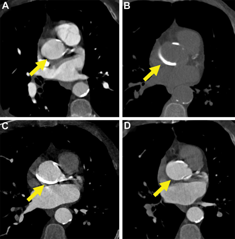 Serial chest CT images in a 68-year-old female patient (patient 1). (A) Axial chest CT image at the level of the aortic root. The nongated chest CT examination was performed to rule out pulmonary embolism before the actual hospitalization. The arrow indicates a normal aortic wall. Two weeks later, the patient underwent invasive coronary angiography for recanalization of the circumflex artery. After the first contrast media injection in the aortic root, extravasation of contrast media into the aortic wall was noticed (image not shown). CT performed 30 minutes after invasive coronary angiography demonstrated a crescent-shaped hyperattenuation, reflecting undiluted contrast media in the aortic wall (Dunning type III; arrow on B, an electrocardiographically [ECG]–gated nonenhanced chest CT image and C, an ECG-gated contrast-enhanced chest CT image). Follow-up CT the following day showed complete resolution of the contrast media accumulation (arrow in D).